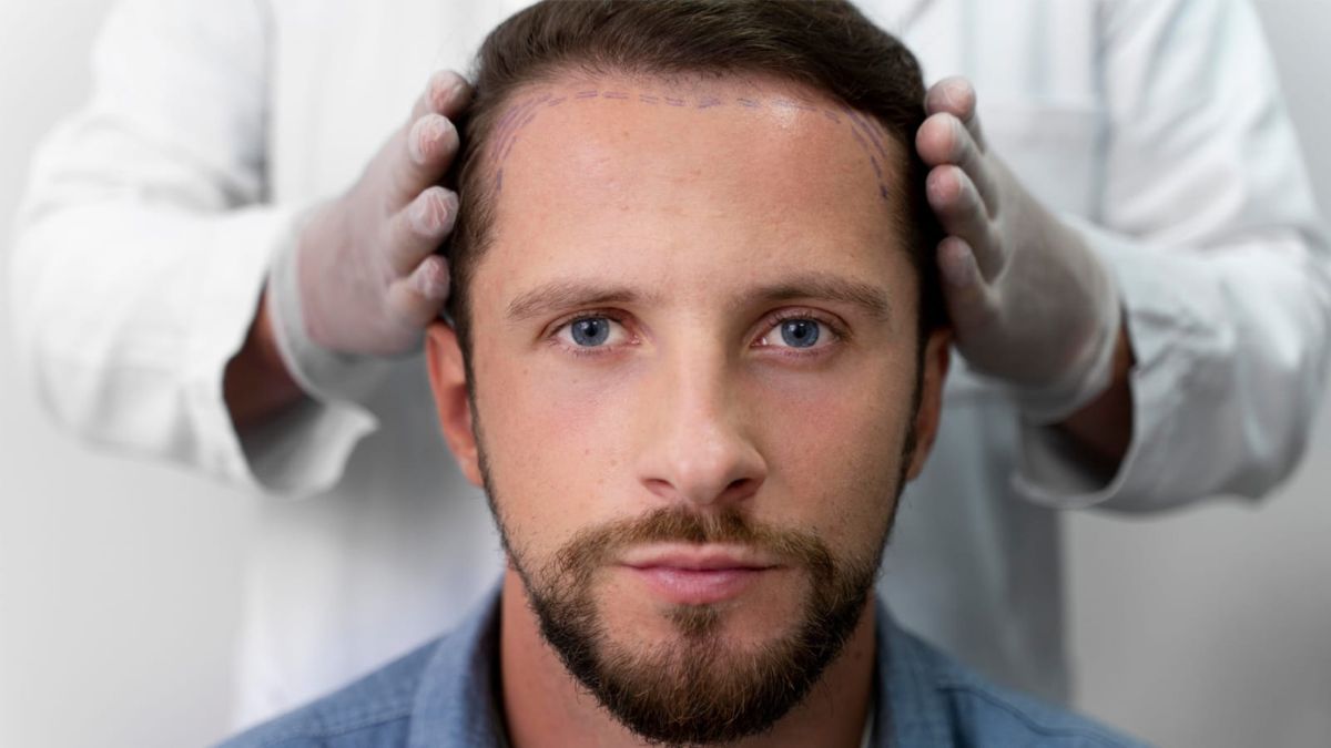 Breaking-Down-Types-of-Hair-Transplant-Techniques-FUT-FUE-DHI-MHI-Explained-by-Dr-Amit-Agarkar